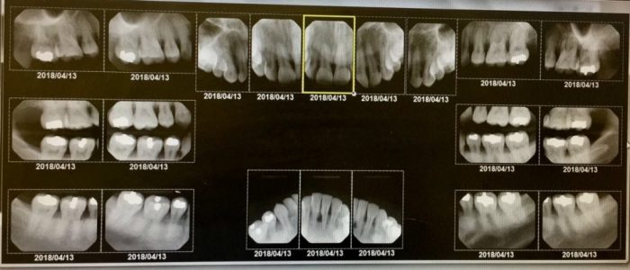 Case study #4 bone breakdown answers