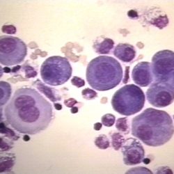 Fluid cells mesothelial pleural