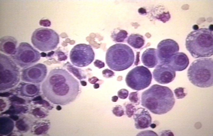 Fluid cells mesothelial pleural