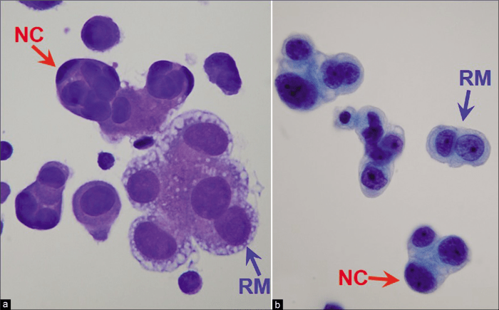 Pleural fluid mesothelial cells vs macrophage