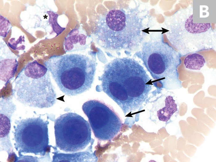 Pleural fluid mesothelial cells vs macrophage